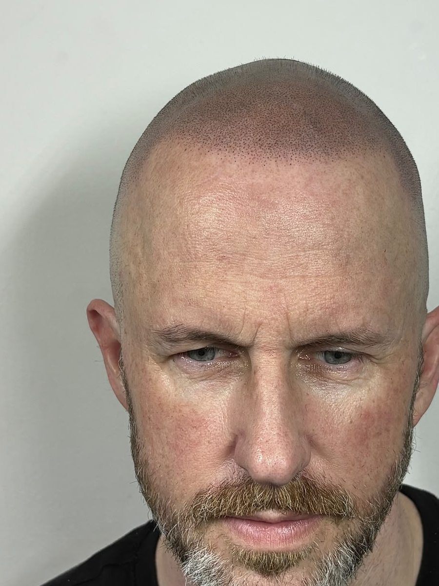 Same client after SMP treatment with a natural, sharp shaved-look hairline