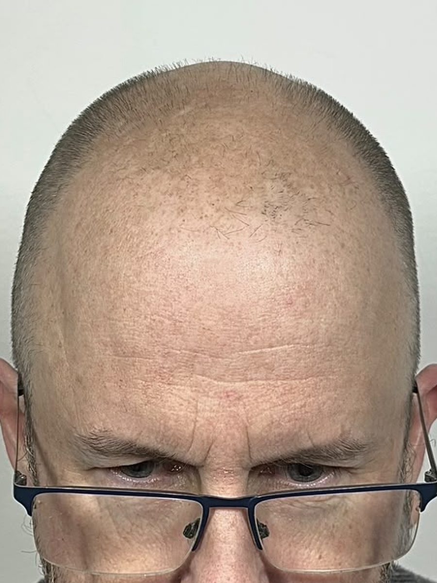 Man with shaved bald head before scalp micropigmentation at SMP by Jack Birmingham