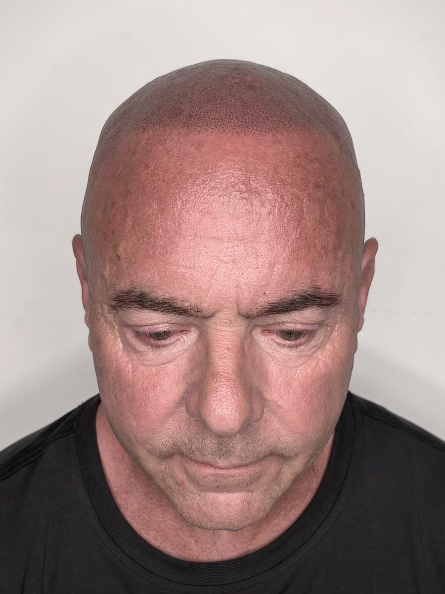 Older client after SMP showing natural shaved-look coverage