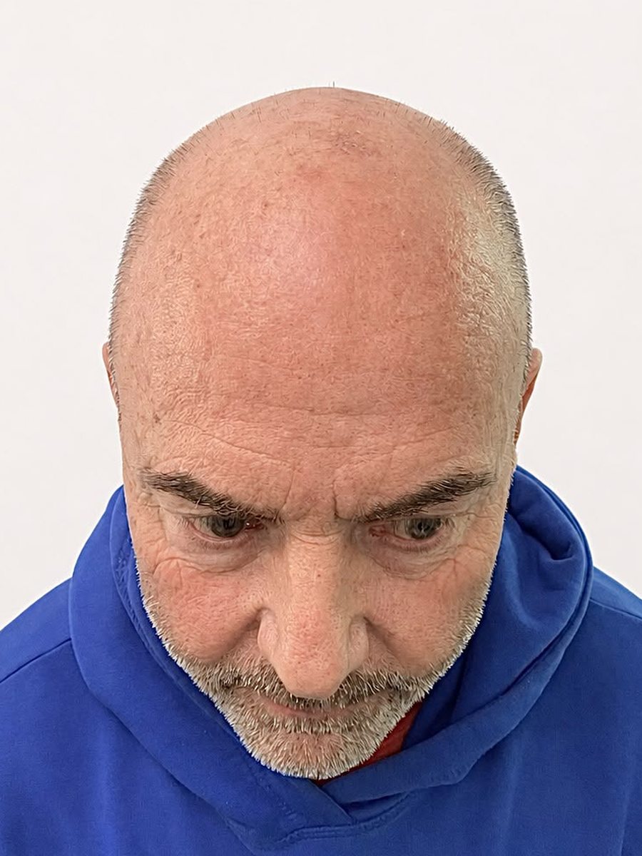 Older man with extensive baldness before scalp micropigmentation
