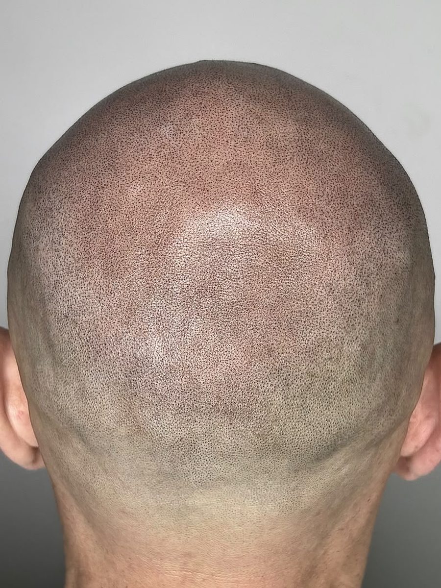 Back of head with even SMP coverage concealing the donor area