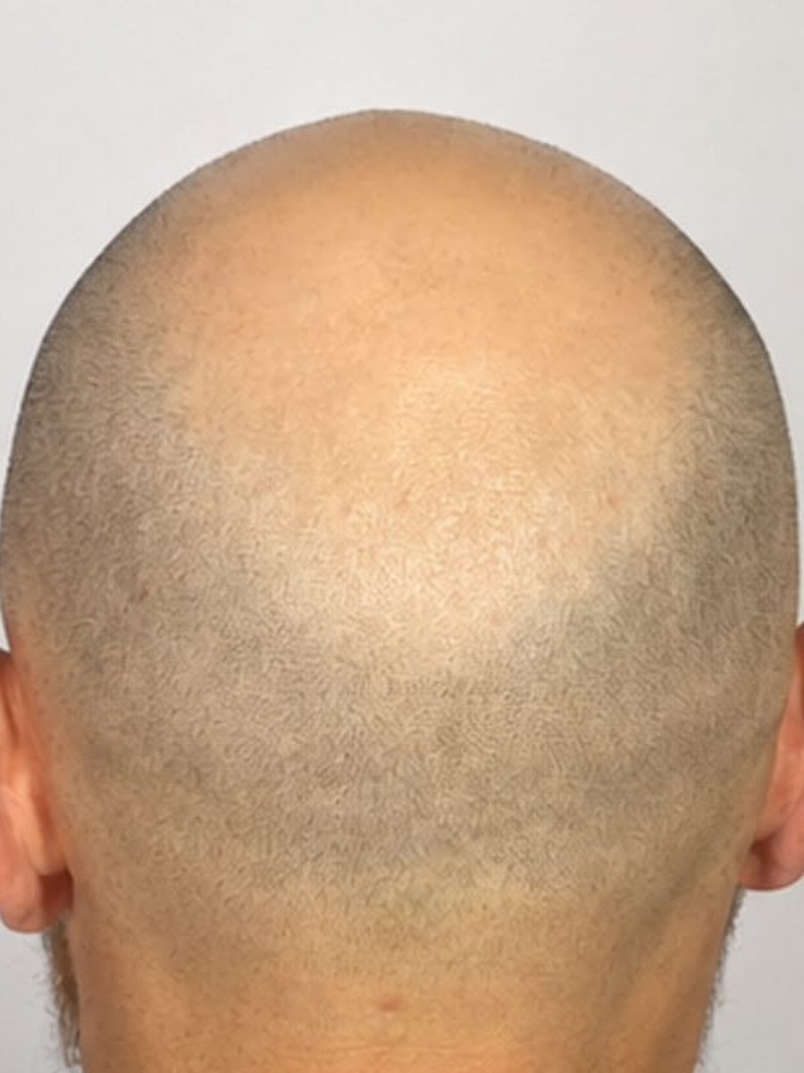 Back of head showing donor area before scar camouflage SMP