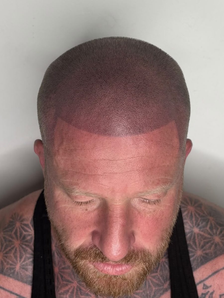 Same client after scalp micropigmentation with restored defined hairline