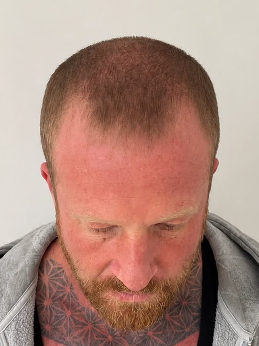 Man with receding red hair before SMP treatment