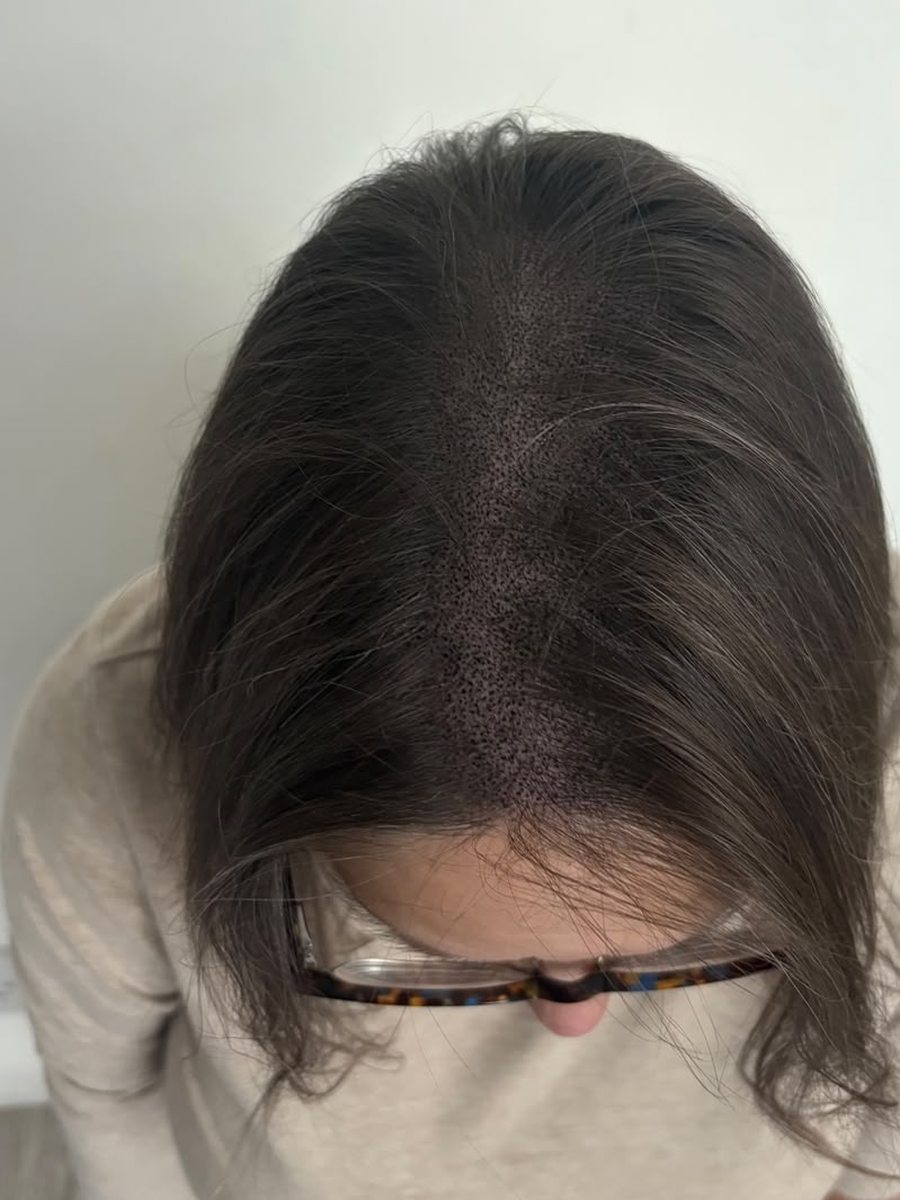 Woman after SMP for density with fuller-looking parting
