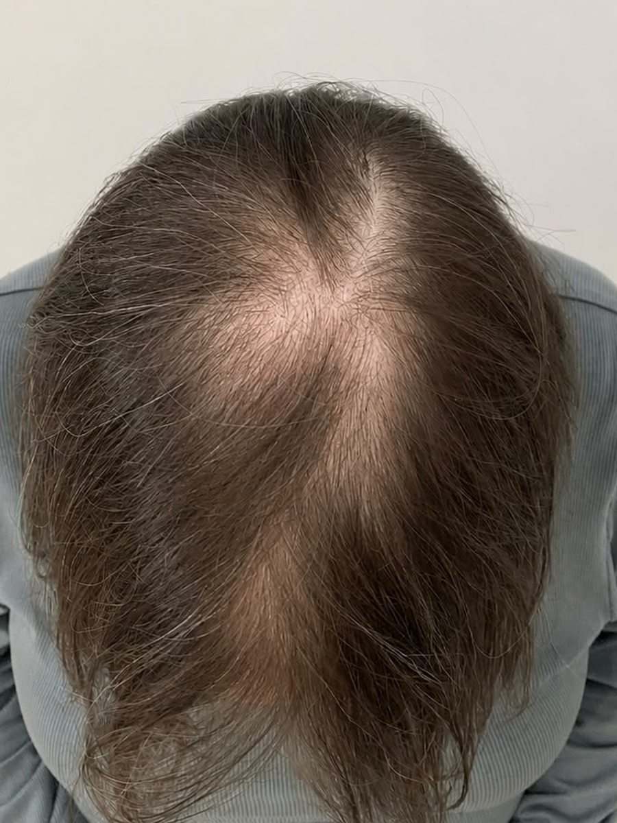 Woman with visible widening parting and thinning hair before SMP