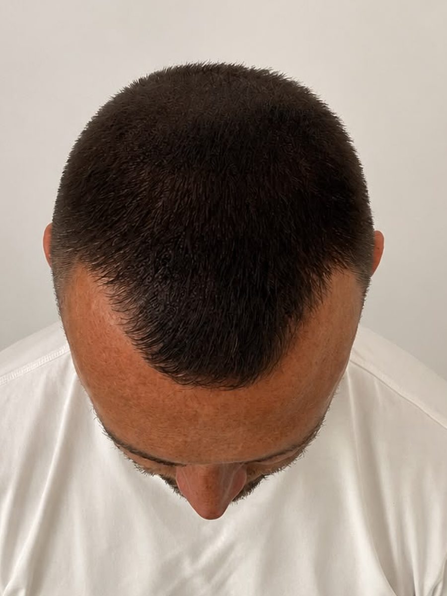 Visibly thicker-looking hair after SMP density treatment through existing hair