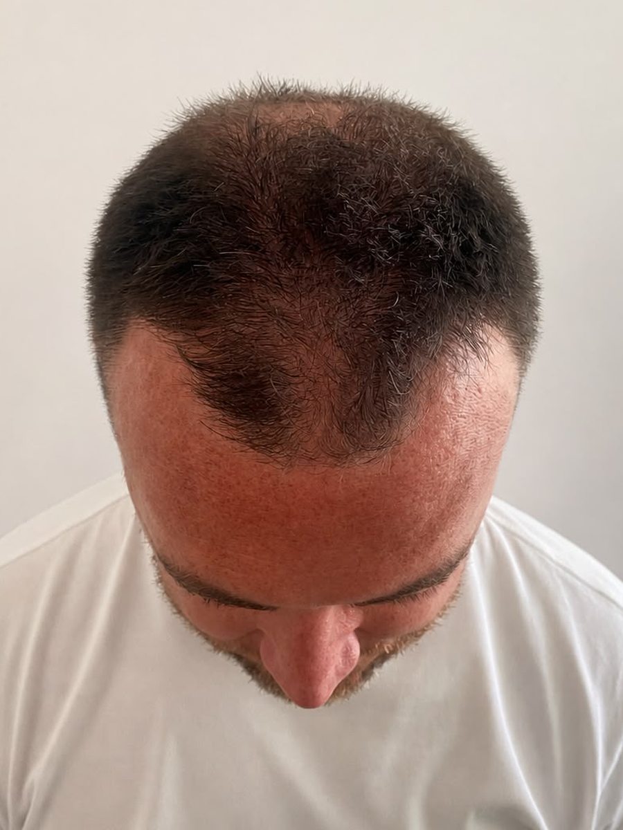 Diffuse thinning through the front and crown before SMP density work